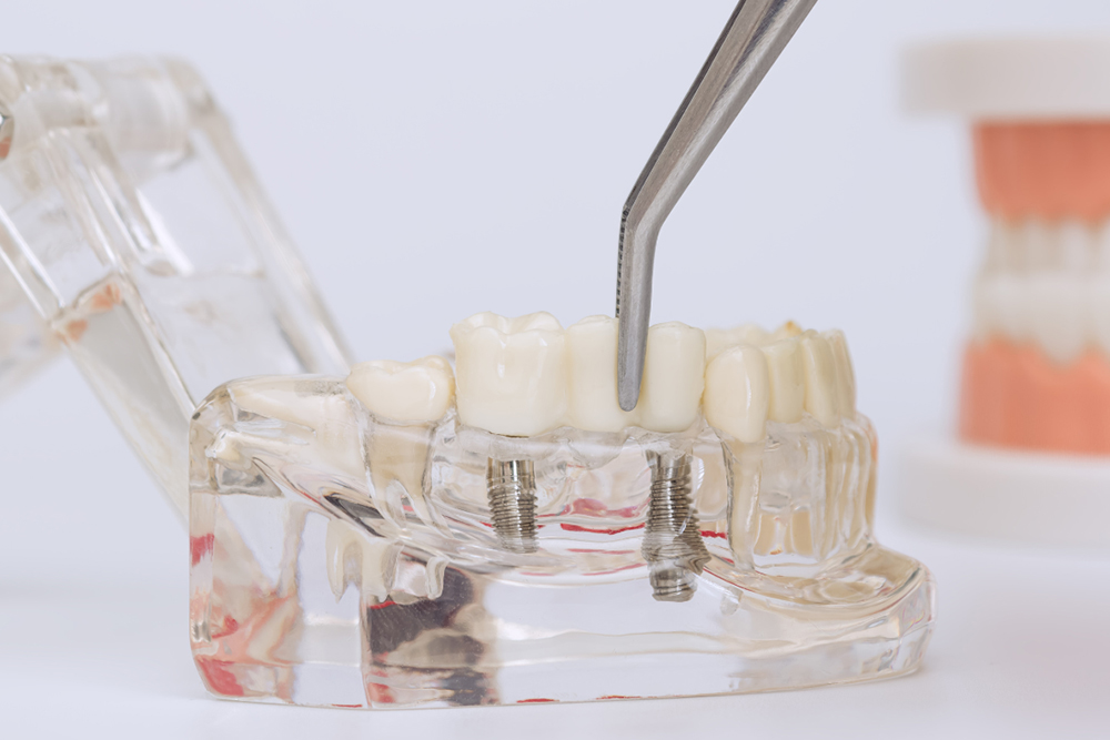 Dental implants failure prevention consultation at Vellore Corners Dentistry