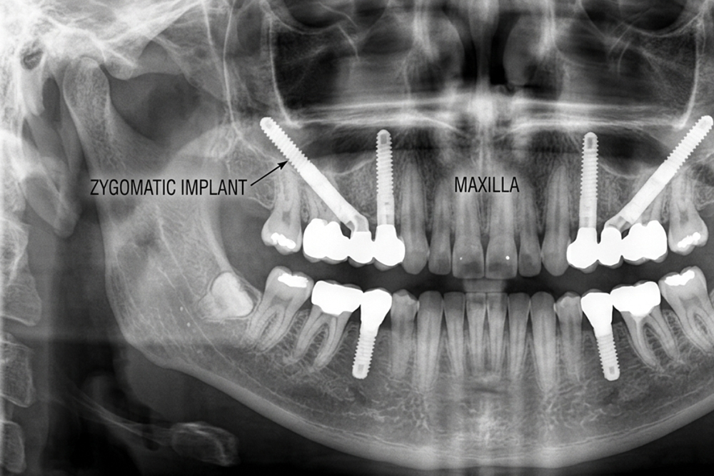 Dental implants zygomatic procedure consultation at Vellore Corners Dentistry